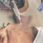 PRP Microneedling Facial | Four Oaks Medicine
